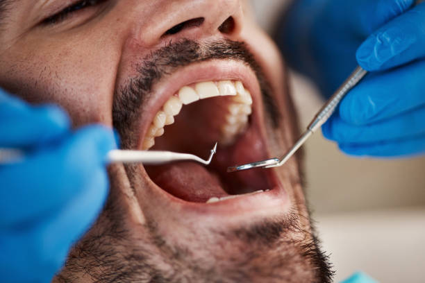 Best Broken or Chipped Tooth Repair in Clifton, TN